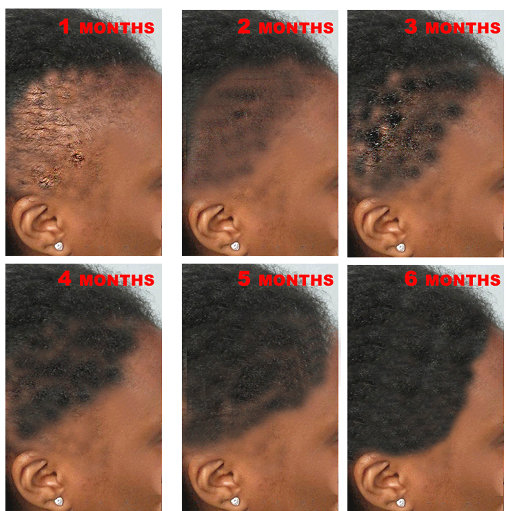 High Quality Home Use 100% Pure Moisturizing Ginger Nourishing Repairing Private Label Fast Hair Growth Oil Serum